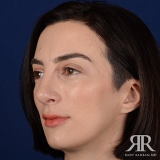 Female Rhinoplasty Before & After Gallery - Patient 315332 - Image 4