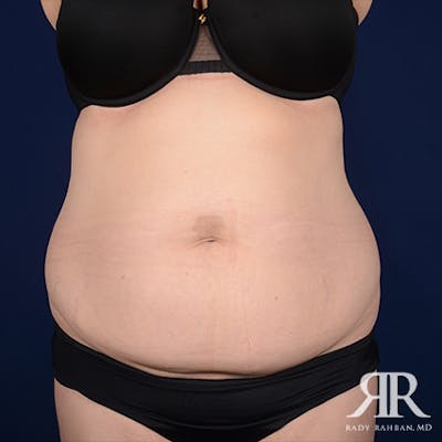 Tummy Tuck Before & After Gallery - Patient 276176 - Image 1