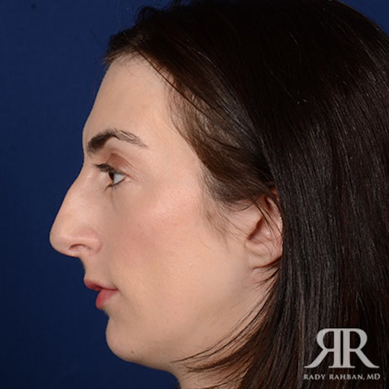 Female Rhinoplasty Before & After Gallery - Patient 315332 - Image 5