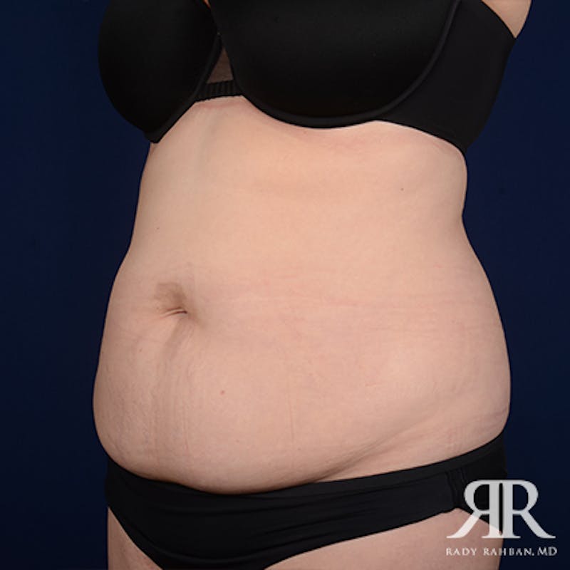Tummy Tuck Before & After Gallery - Patient 276176 - Image 3