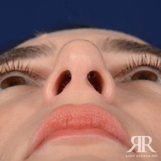 Female Rhinoplasty Before & After Gallery - Patient 315332 - Image 8