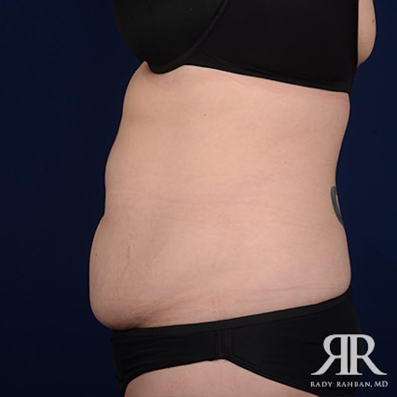 Tummy Tuck Before & After Gallery - Patient 276176 - Image 5