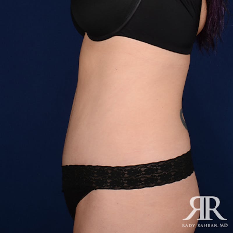 Tummy Tuck Before & After Gallery - Patient 276176 - Image 6