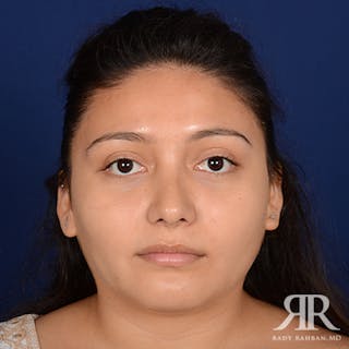 Female Rhinoplasty Before & After Gallery - Patient 183316 - Image 2
