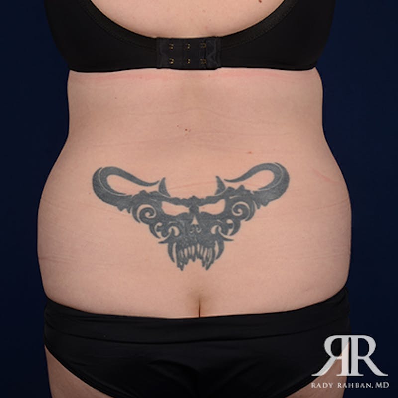Tummy Tuck Before & After Gallery - Patient 276176 - Image 7