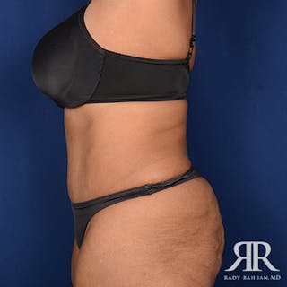 Severe Diastasis Recti Before & After Gallery - Patient 194023 - Image 6