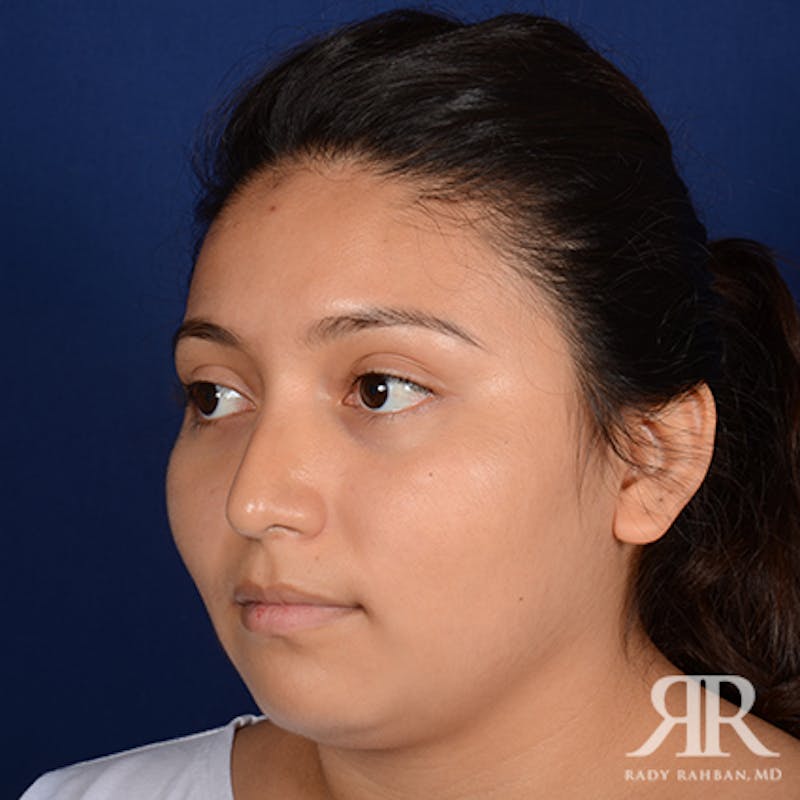 Female Rhinoplasty Before & After Gallery - Patient 183316 - Image 3