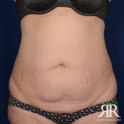 Severe Diastasis Recti Before & After Gallery - Patient 278511 - Image 1