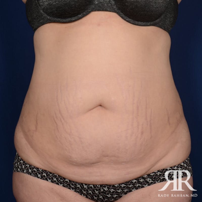Severe Diastasis Recti Before & After Gallery - Patient 278511 - Image 1