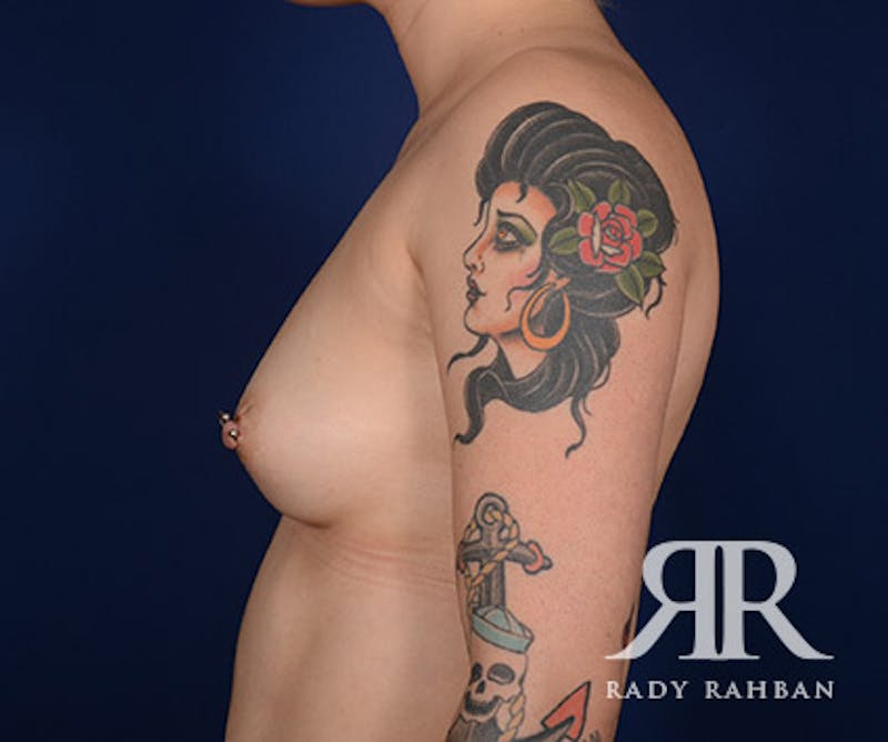 Breast Augmentation Before & After Gallery - Patient 255975 - Image 5