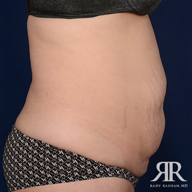 Severe Diastasis Recti Before & After Gallery - Patient 278511 - Image 5