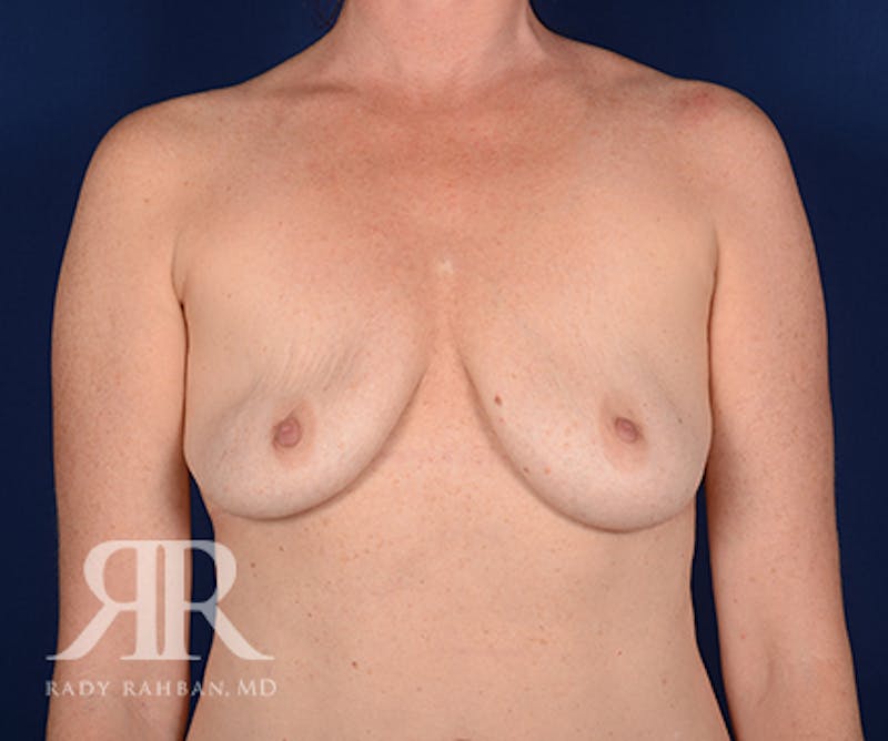 Corrective Breast Surgery Before & After Gallery - Patient 710913 - Image 1