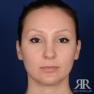 Female Rhinoplasty Before & After Gallery - Patient 355162 - Image 2