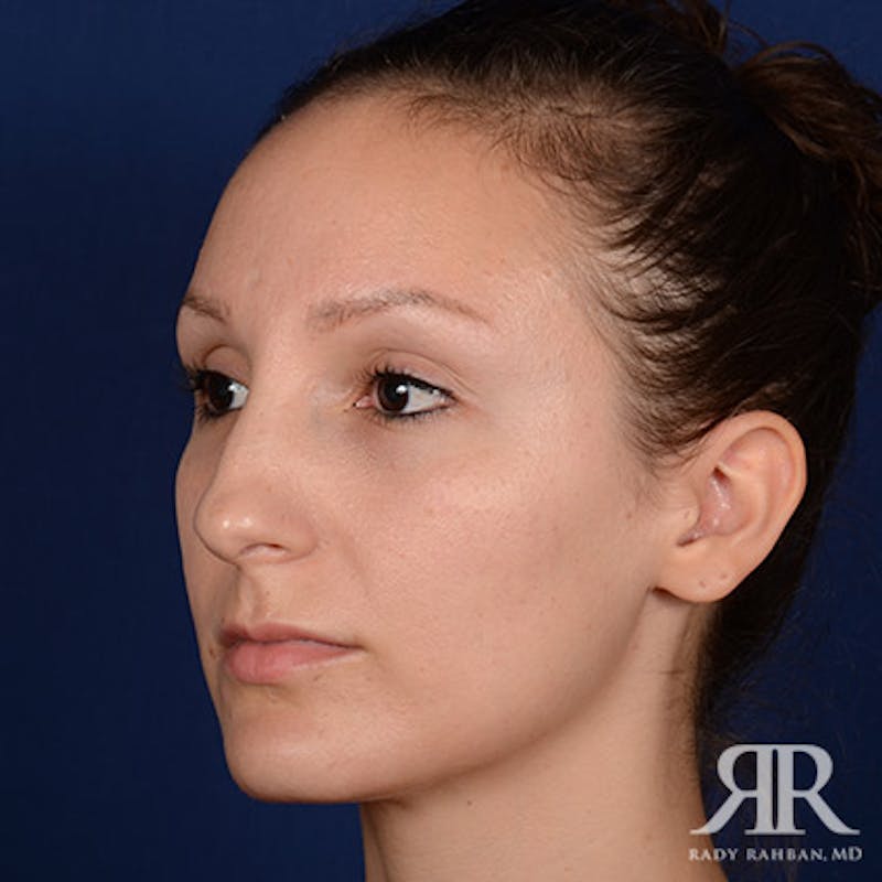 Female Rhinoplasty Before & After Gallery - Patient 355162 - Image 3