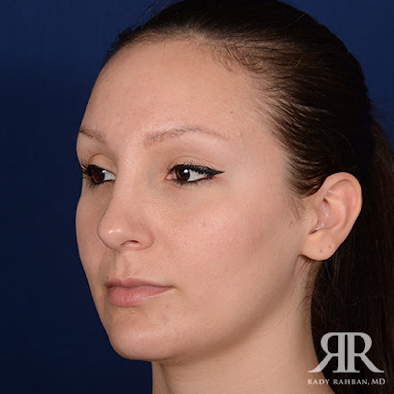 Female Rhinoplasty Before & After Gallery - Patient 355162 - Image 4