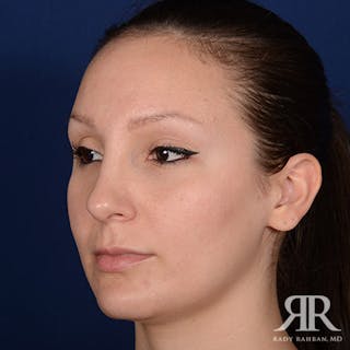 Female Rhinoplasty Before & After Gallery - Patient 355162 - Image 4