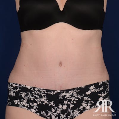 Severe Diastasis Recti Before & After Gallery - Patient 356896 - Image 2
