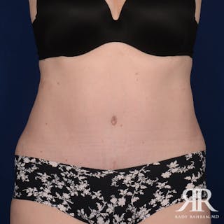 Severe Diastasis Recti Before & After Gallery - Patient 356896 - Image 2
