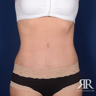 Tummy Tuck Before & After Gallery - Patient 435799 - Image 2
