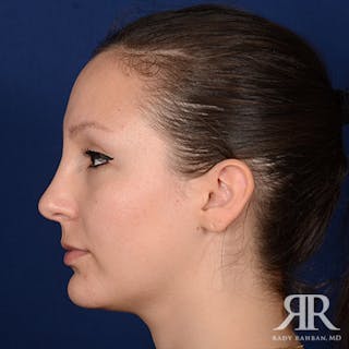 Female Rhinoplasty Before & After Gallery - Patient 355162 - Image 6
