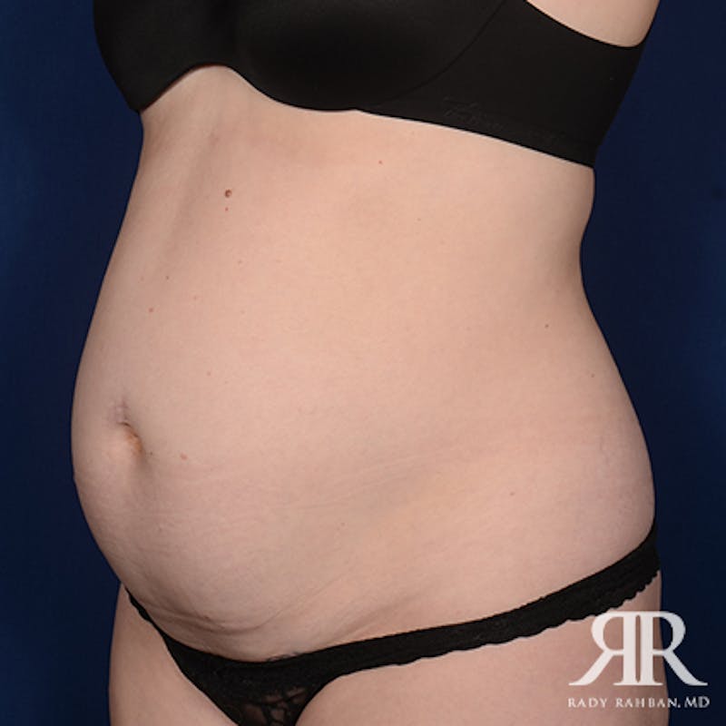 Severe Diastasis Recti Before & After Gallery - Patient 356896 - Image 3