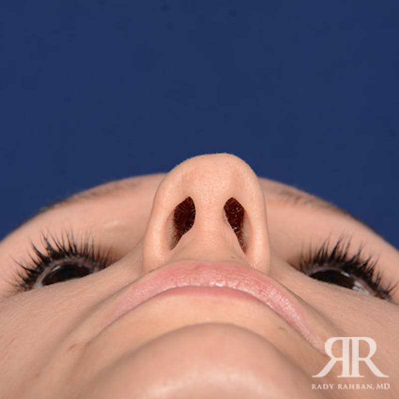 Female Rhinoplasty Before & After Gallery - Patient 355162 - Image 7