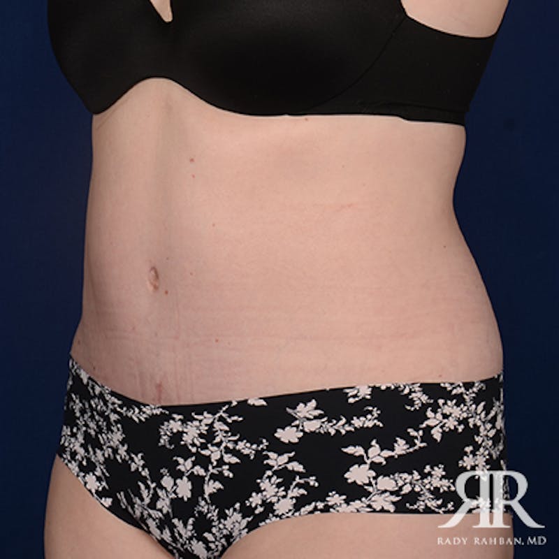 Severe Diastasis Recti Before & After Gallery - Patient 356896 - Image 4