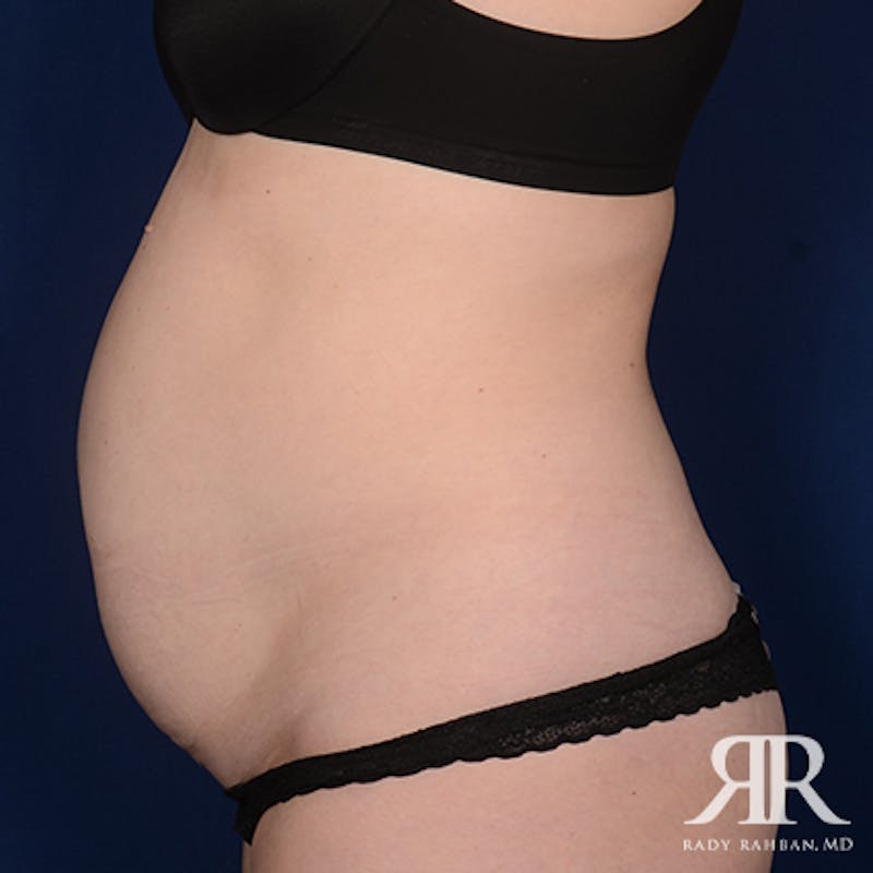 Severe Diastasis Recti Before & After Gallery - Patient 356896 - Image 5
