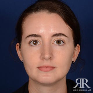 Female Rhinoplasty Before & After Gallery - Patient 139864 - Image 2