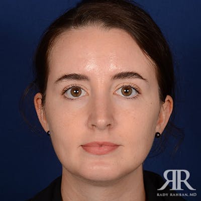 Female Rhinoplasty Before & After Gallery - Patient 139864 - Image 2