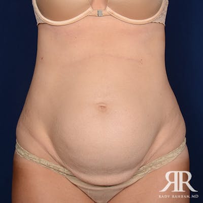 Severe Diastasis Recti Before & After Gallery - Patient 423493 - Image 1