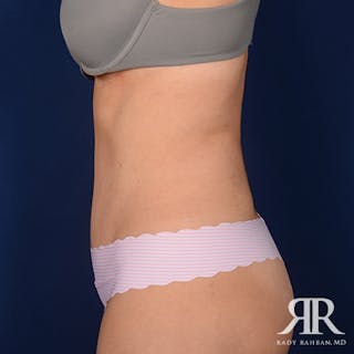Tummy Tuck Before & After Gallery - Patient 300238 - Image 6