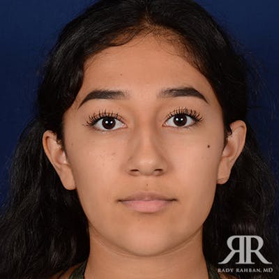 Female Rhinoplasty Before & After Gallery - Patient 420147 - Image 1