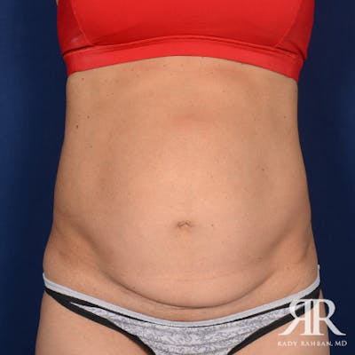 Severe Diastasis Recti Before & After Gallery - Patient 927634 - Image 1