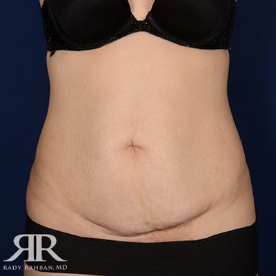 Tummy Tuck Before & After Gallery - Patient 427617 - Image 1