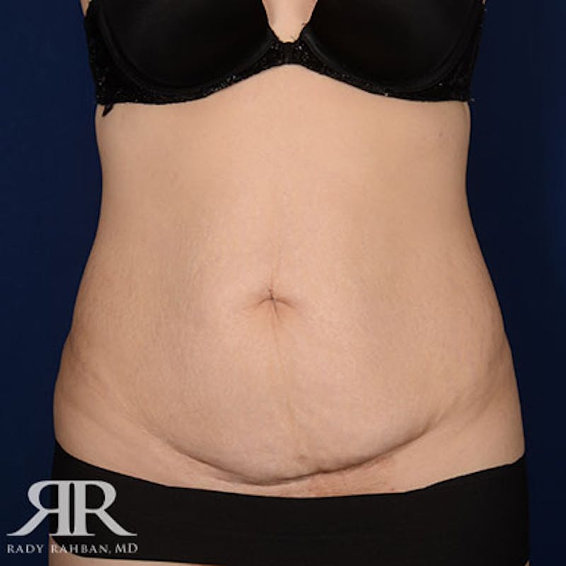 Tummy Tuck Before & After Gallery - Patient 427617 - Image 1