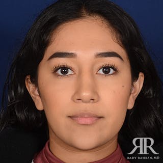 Female Rhinoplasty Before & After Gallery - Patient 420147 - Image 2