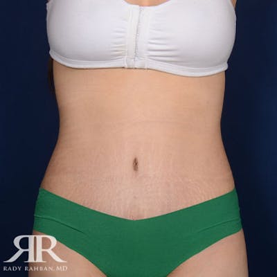Tummy Tuck Before & After Gallery - Patient 427617 - Image 2
