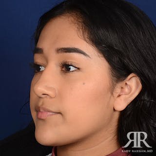 Female Rhinoplasty Before & After Gallery - Patient 420147 - Image 4