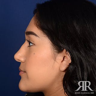 Female Rhinoplasty Before & After Gallery - Patient 420147 - Image 6