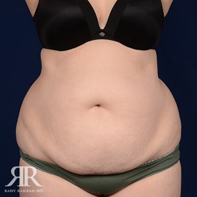 Tummy Tuck Before & After Gallery - Patient 101404 - Image 1