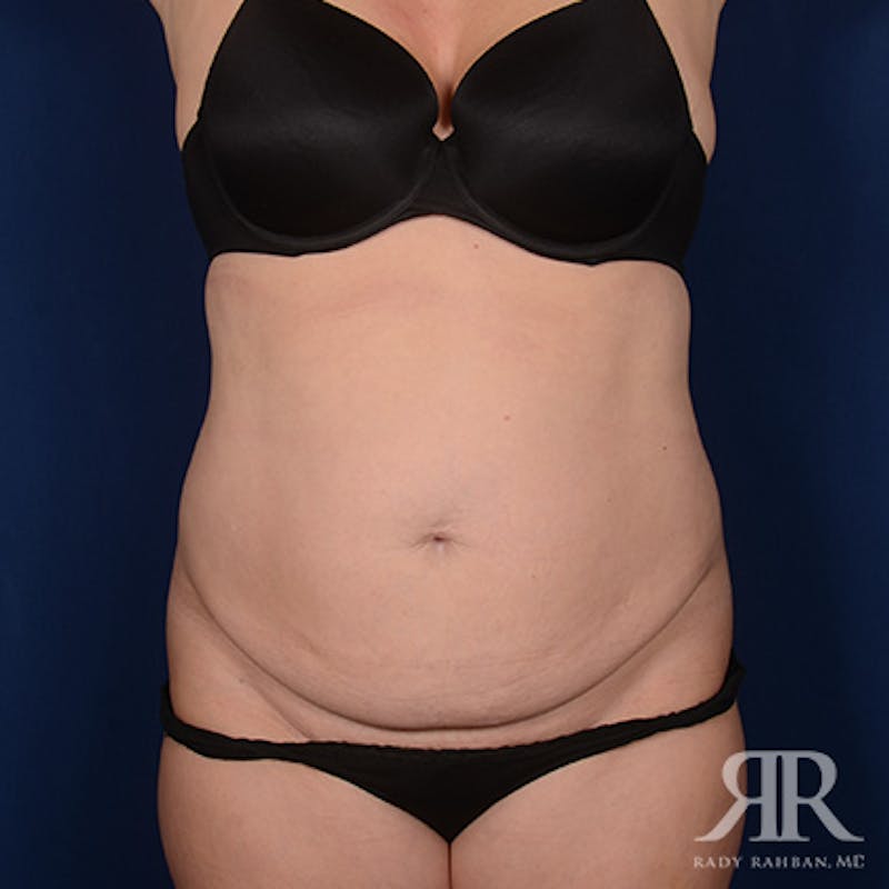 Severe Diastasis Recti Before & After Gallery - Patient 958341 - Image 1