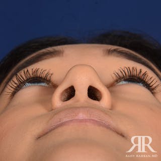 Female Rhinoplasty Before & After Gallery - Patient 420147 - Image 8