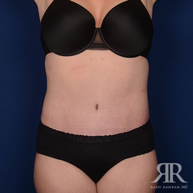 Severe Diastasis Recti Before & After Gallery - Patient 958341 - Image 2