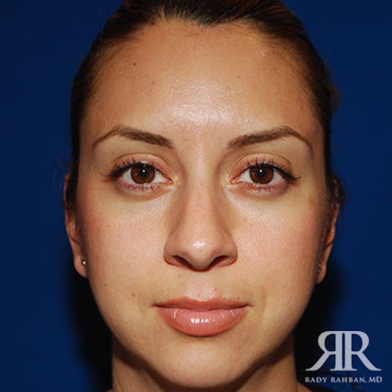 Female Rhinoplasty Before & After Gallery - Patient 173780 - Image 1