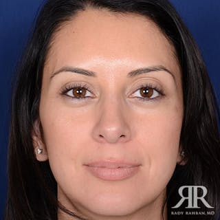 Female Rhinoplasty Before & After Gallery - Patient 173780 - Image 2
