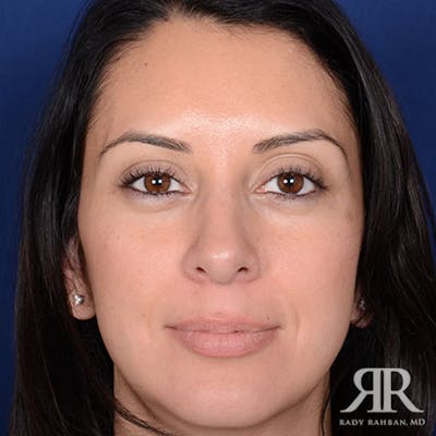 Female Rhinoplasty Before & After Gallery - Patient 173780 - Image 2