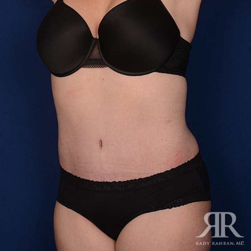 Severe Diastasis Recti Before & After Gallery - Patient 958341 - Image 4