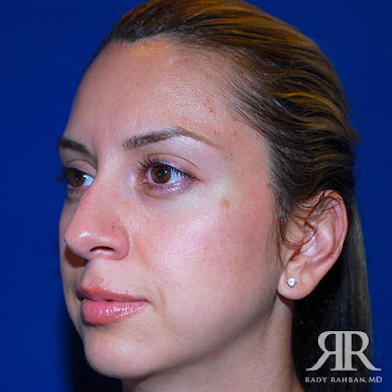 Female Rhinoplasty Before & After Gallery - Patient 173780 - Image 3
