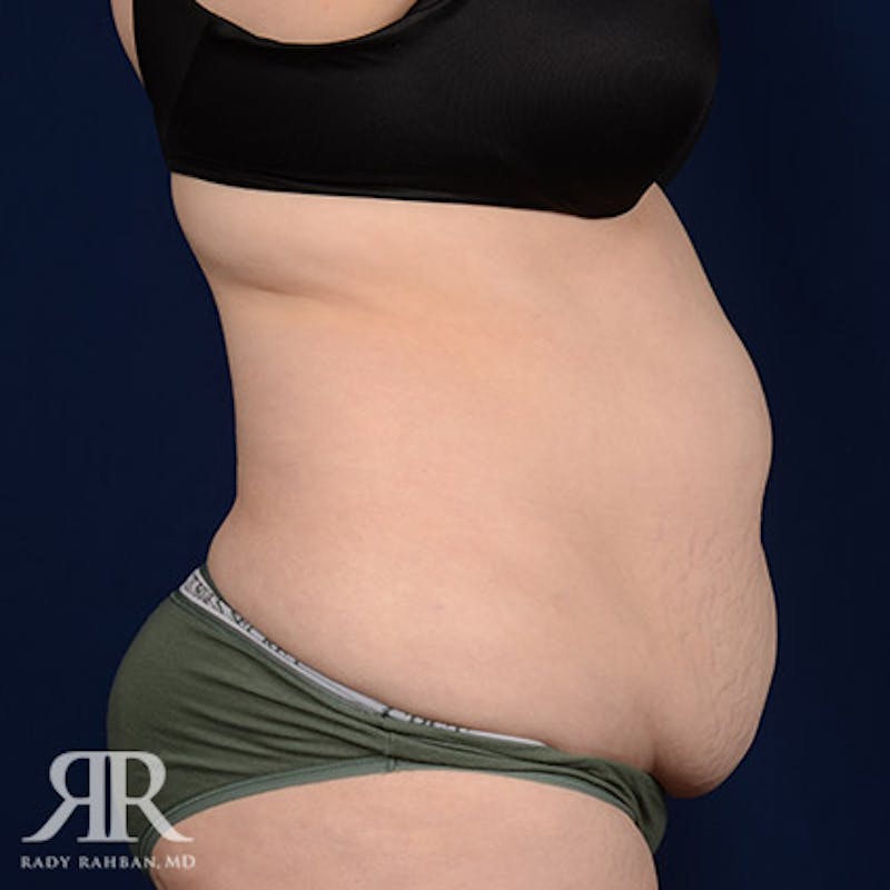 Tummy Tuck Before & After Gallery - Patient 101404 - Image 5